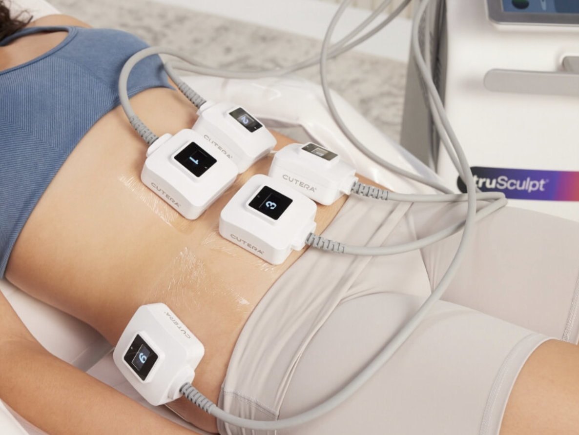 truSculpt body contouring treatment on abdomen using Cutera applicators for non-invasive fat reduction and body sculpting.